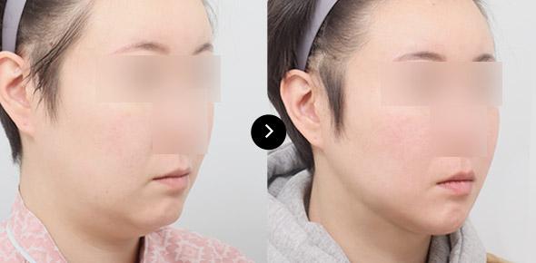 Lifting Benang Double-chin image 2