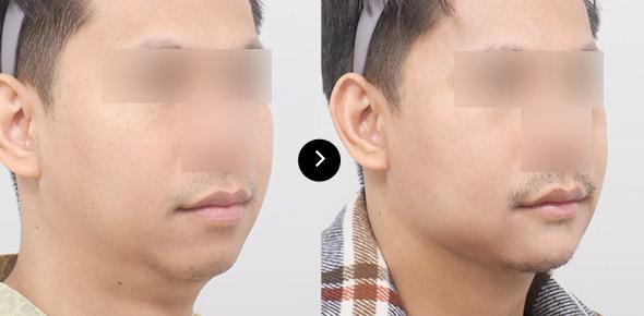 Lifting Benang Double-chin image 3