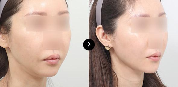 Lifting Benang Double-chin image 4