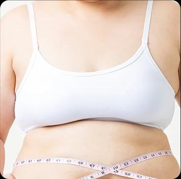 Gigantomastia Akibat Obesitas