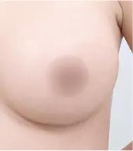 1 bulan setelah operasi