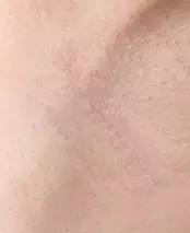 Area sayatan ketiak
1 bulan setelah operasi