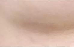 3 bulan setelah operasi