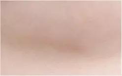 10 bulan setelah operasi