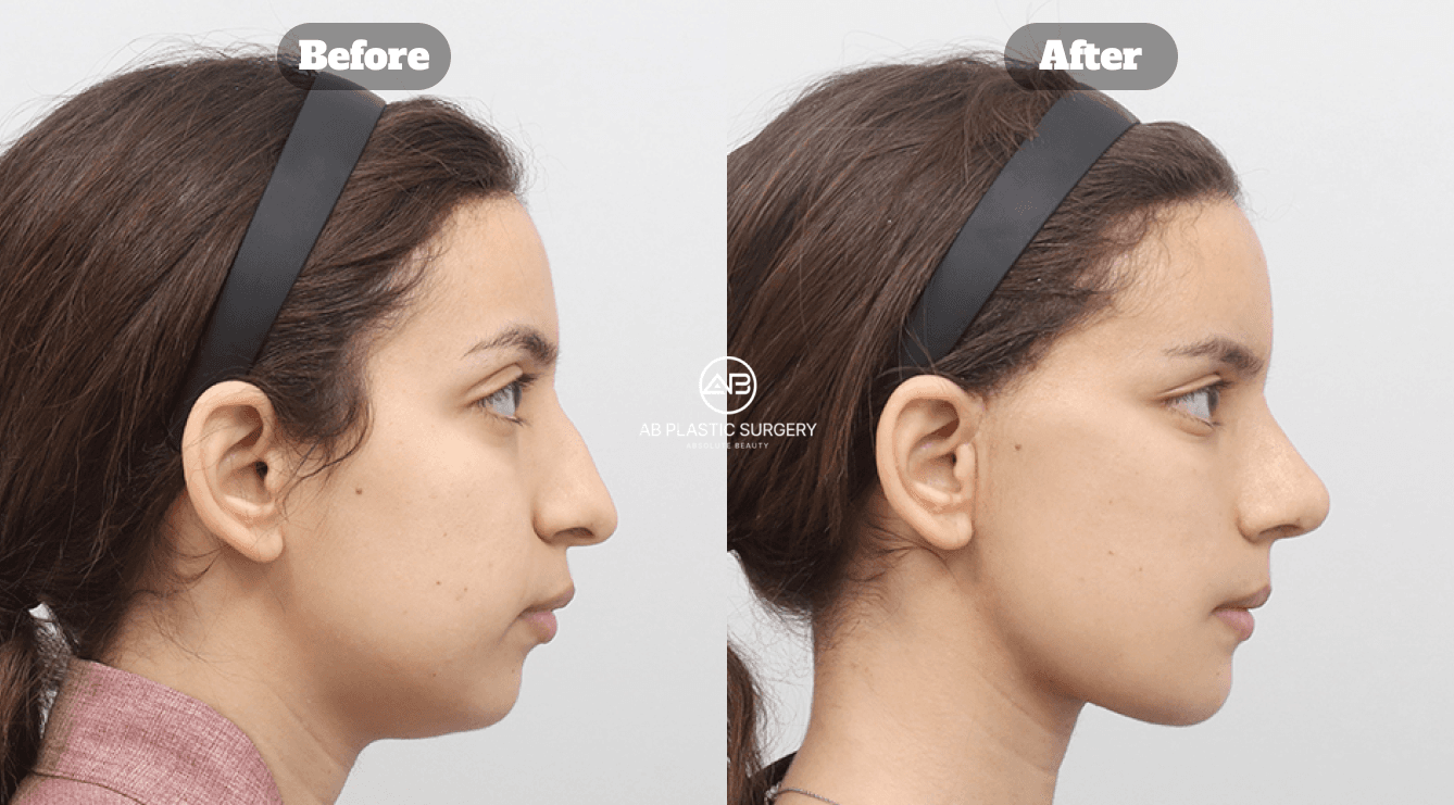 Harga Rhinoplasty di Korea: Hal Apa Saja yang Menentukan Biaya Operasi Hidung?