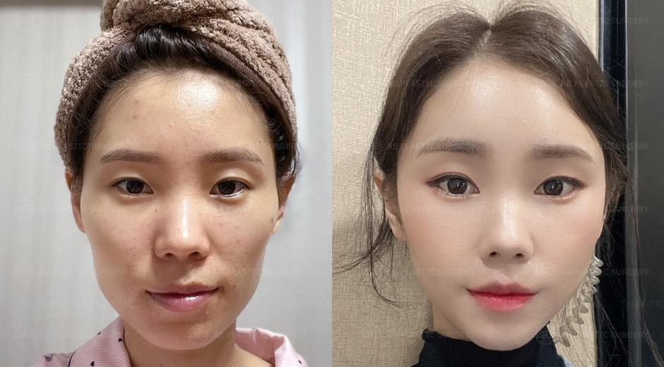Aku tidak pernah menyesali glow-up ku ini! <Kontur Wajah 3 Jenis, Full-Face Fat Grafting>