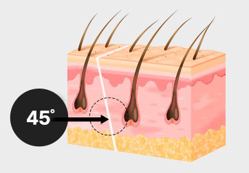 Sayatan diagonal untuk mengurangi efek samping, seperti rambut rontok