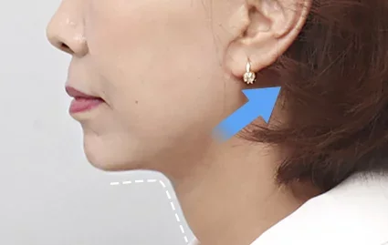 2 Bulan Setelah Operasi