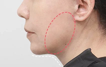 1 Bulan Setelah Operasi