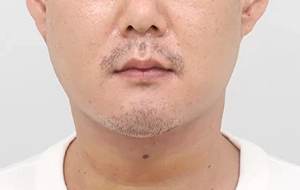 1 Minggu Setelah Operasi