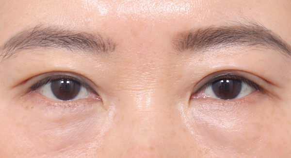 Garis alami yang menempel kuat,
tidak kendur bahkan setelah 1 bulan