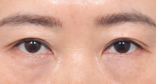 Dengan kontrol fiksasi otot mata yang tepat,
garis yang terbebas dari bekas luka bahkan setelah 6 bulan