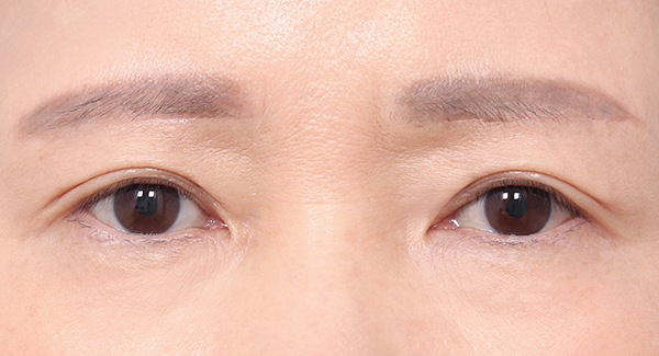 1 Bulan
Setelah Operasi