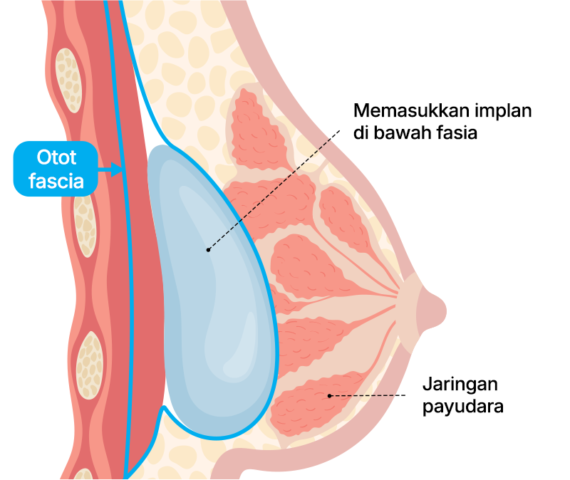 Metode Operasi Penyisipan Subfasial