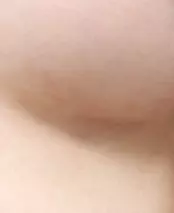 Area sayatan lipatan bawah payudara 2 bulan setelah operasi