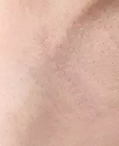 Area sayatan ketiak 
1 bulan setelah operasi