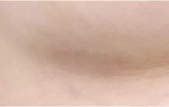 3 bulan setelah operasi