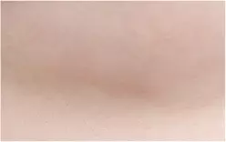 10 bulan setelah operasi