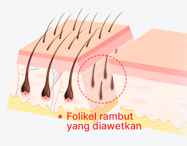 Pelestarian folikel rambut melalui sayatan diagonal 45 derajat