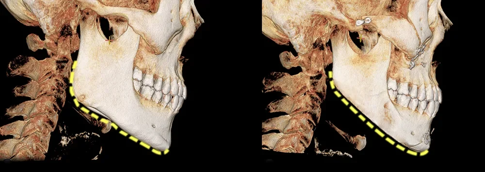 Facial contouring CT before and after 2