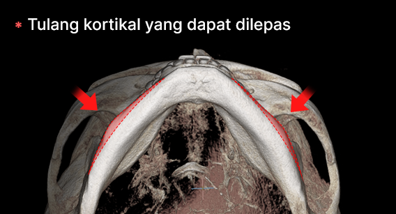 Memotong tulang kortikal untuk efek dari sisi depan.