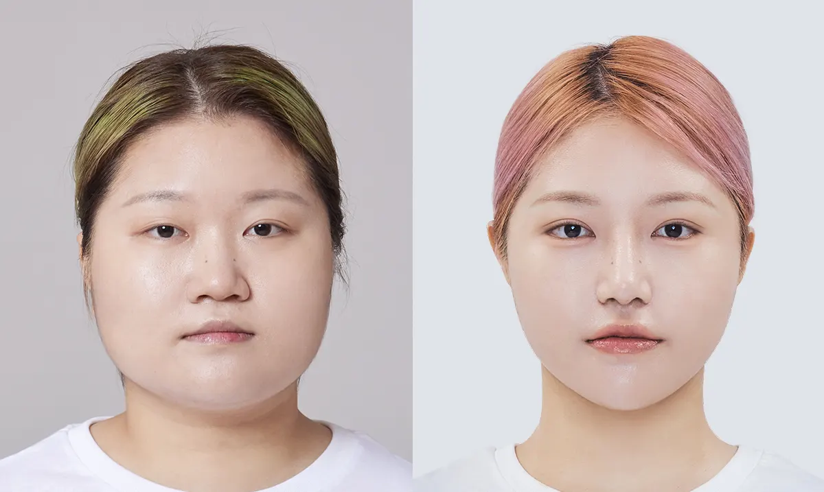 맥미걸 악플콜렉터 수술 전후 의학 사진