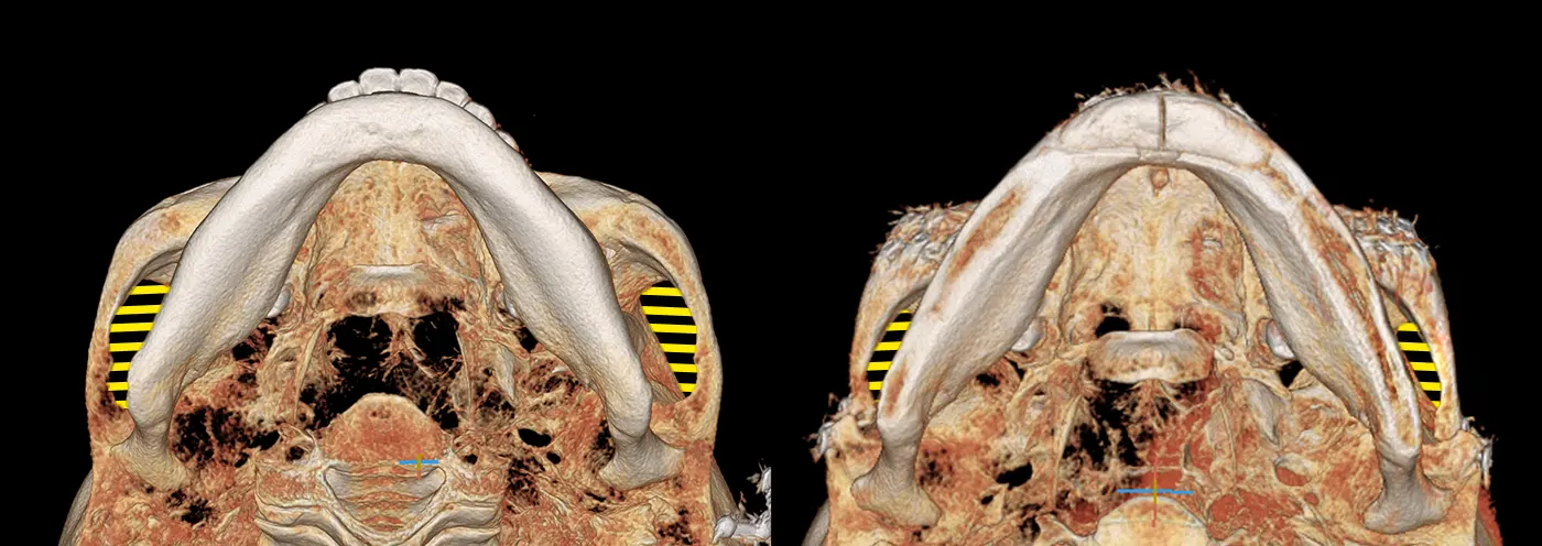 맥미걸 악플콜렉터 수술 전후 ct 사진