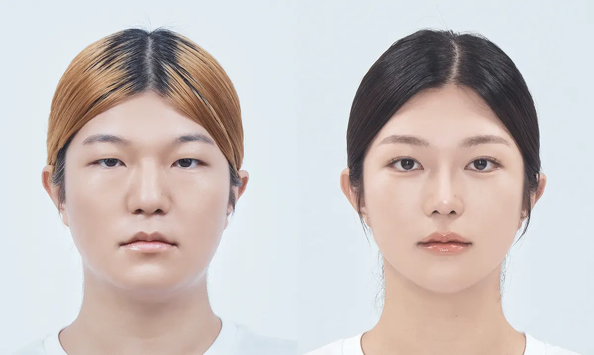 Before and After Surgery