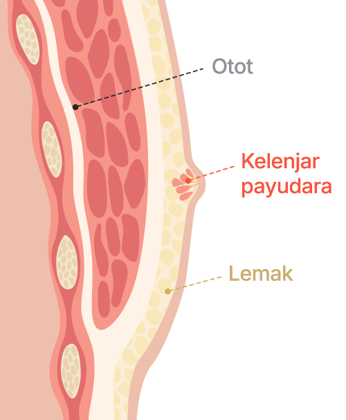 Gynecomastia surgery