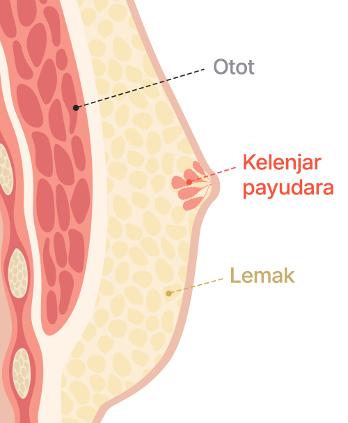 Gynecomastia surgery