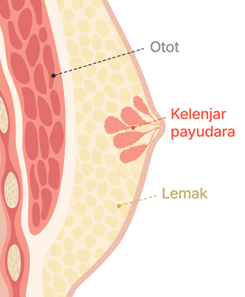Gynecomastia surgery