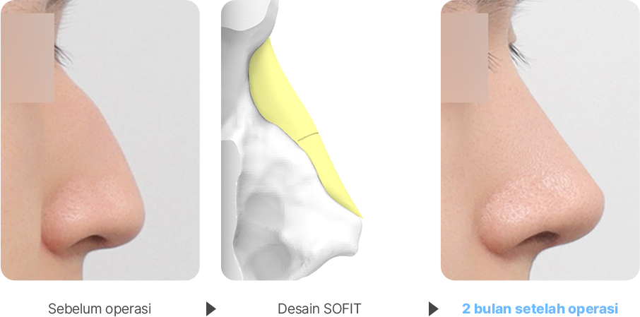 Severe Hump case