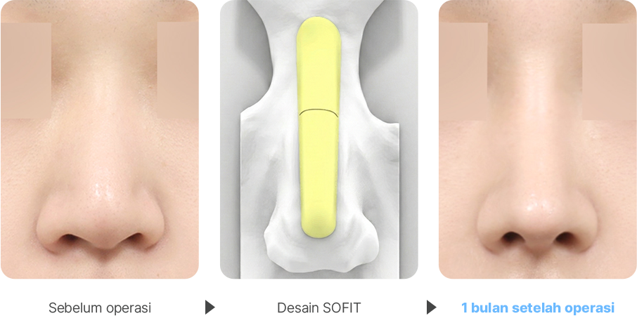 Deviated Nose case