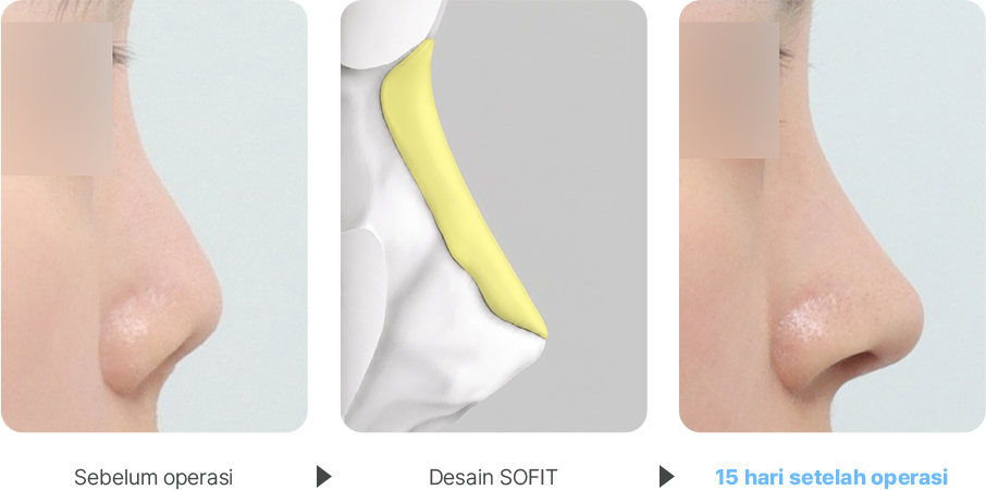Contracted Nose case
