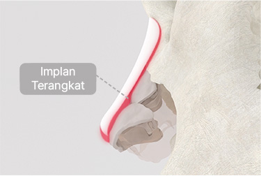 Operasi Hidung Biasa