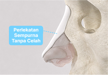 Operasi Hidung 3D Khusus, SOFIT