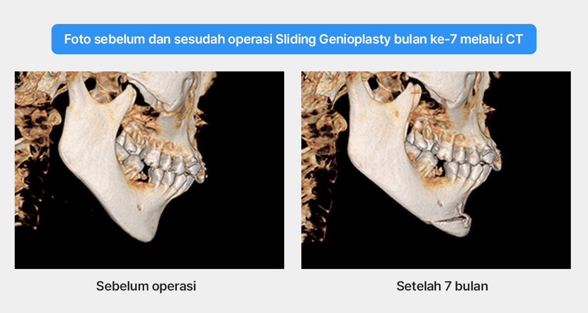 dagu pendek