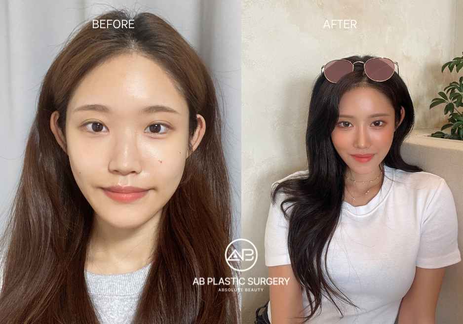 Plastic Surgery in Korea