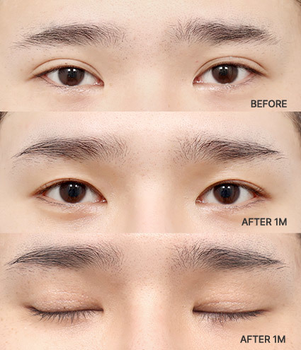 1 Bulan Setelah Revisi Blepharoplasty di AB Plastic Surgery Korea