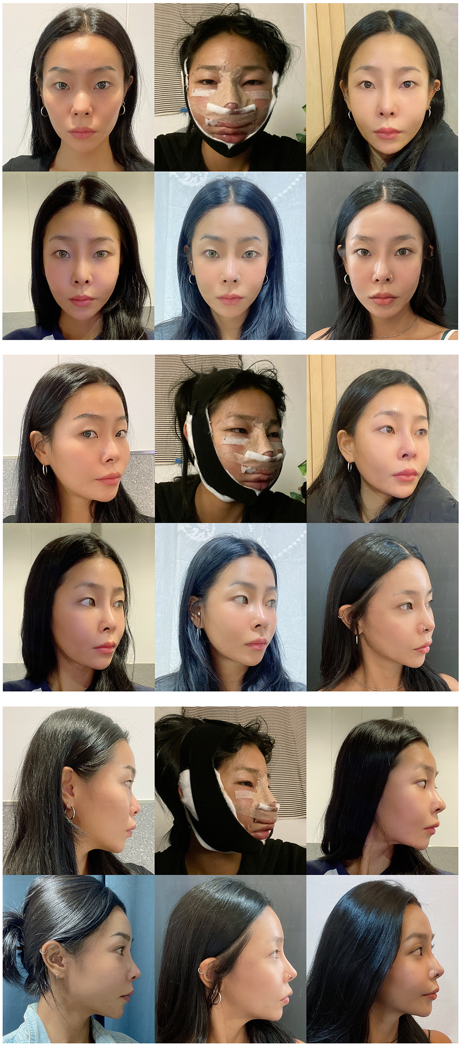 Sebelum dan Sesudah Rhinoplasty di AB Plastic Surgery Korea