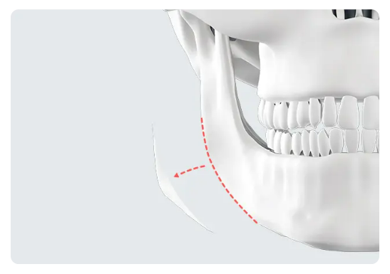 Operasi Pengurangan Jaw Square Korea