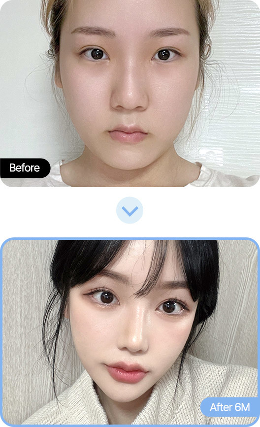 Hasil Operasi Plastik Aman di AB Plastic Surgery Korea