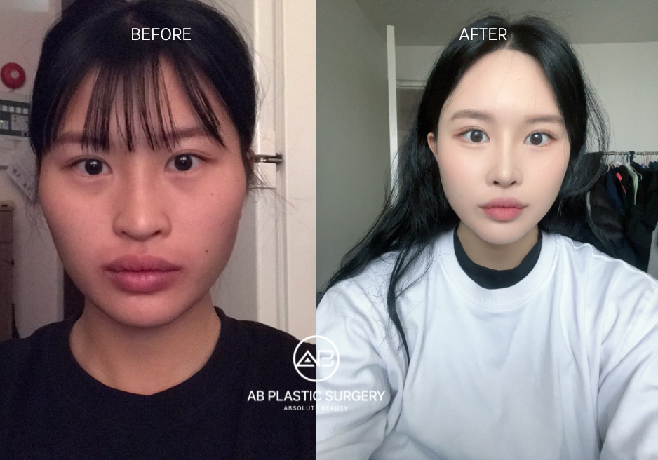 Hasil Contouring Wajah di Korea