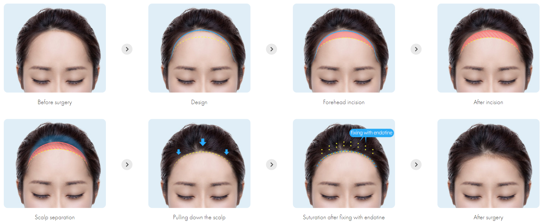 Cara Operasi Pengurangan Kening Dilakukan