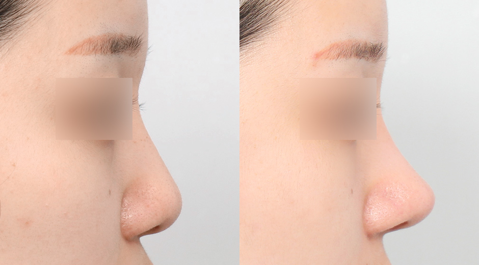 Rhinoplasty in Korea