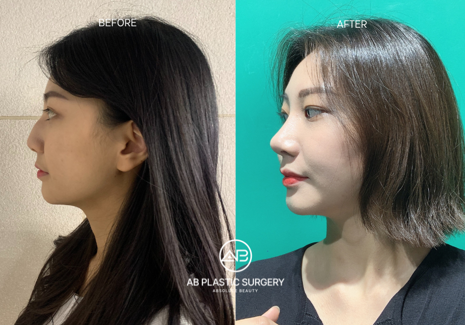 Nose Job di Korea. Sebelum dan Sesudah