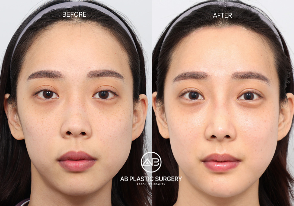 Hasil Operasi Pengurangan Kening di Korea