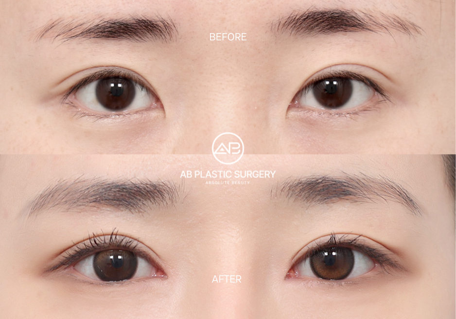 Hasil Bedah Canthoplasty Lateral dan Bawah