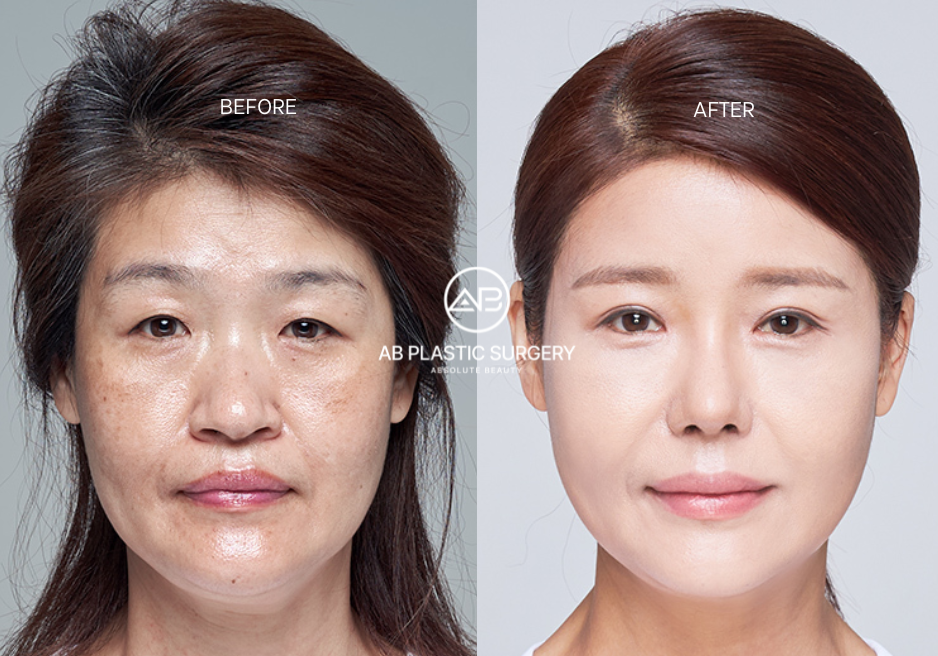 Sebelum dan Sesudah Thread Lift di AB Plastic Surgery Korea