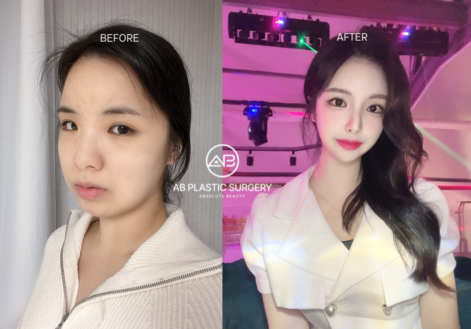 Bedah Wajah Lebar di AB Plastic Surgery Korea